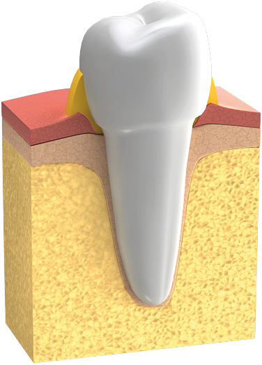 Parodontologie : Erkranktes Zahnfleisch ist gerötet, blutet leicht und ist am Zahnhals häufig leicht geschwollen.