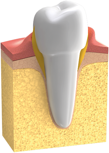 Parodontologie : Bei Fortschreiten der Entzündung zieht sich das Zahnfleisch zwischen den Zähnen zurück. Es ist gerötet und teilweise deutlich geschwollen.