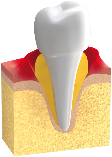 Parodontologie : Durch den Verlust an Knochensubstanz sind die Zähne bei Parodontitis bereits gelockert.