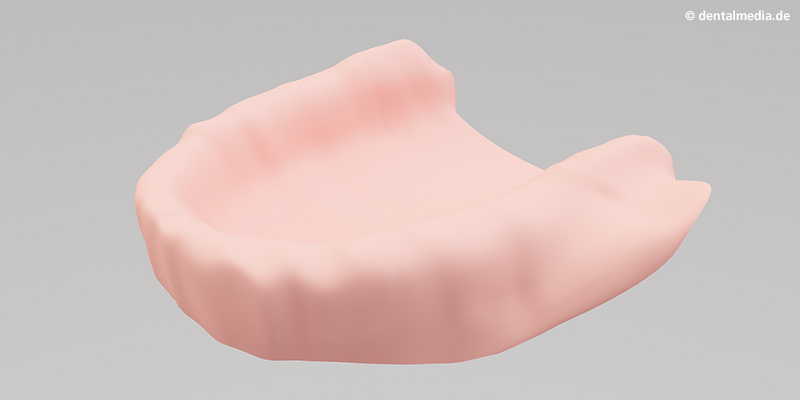 Vollprothesen : Zahnloser Kieferknochen